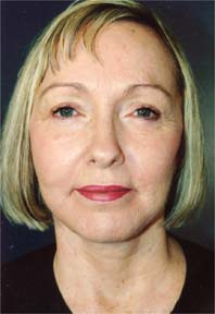 File:Cincinnati lipo laser treatment 944.jpg